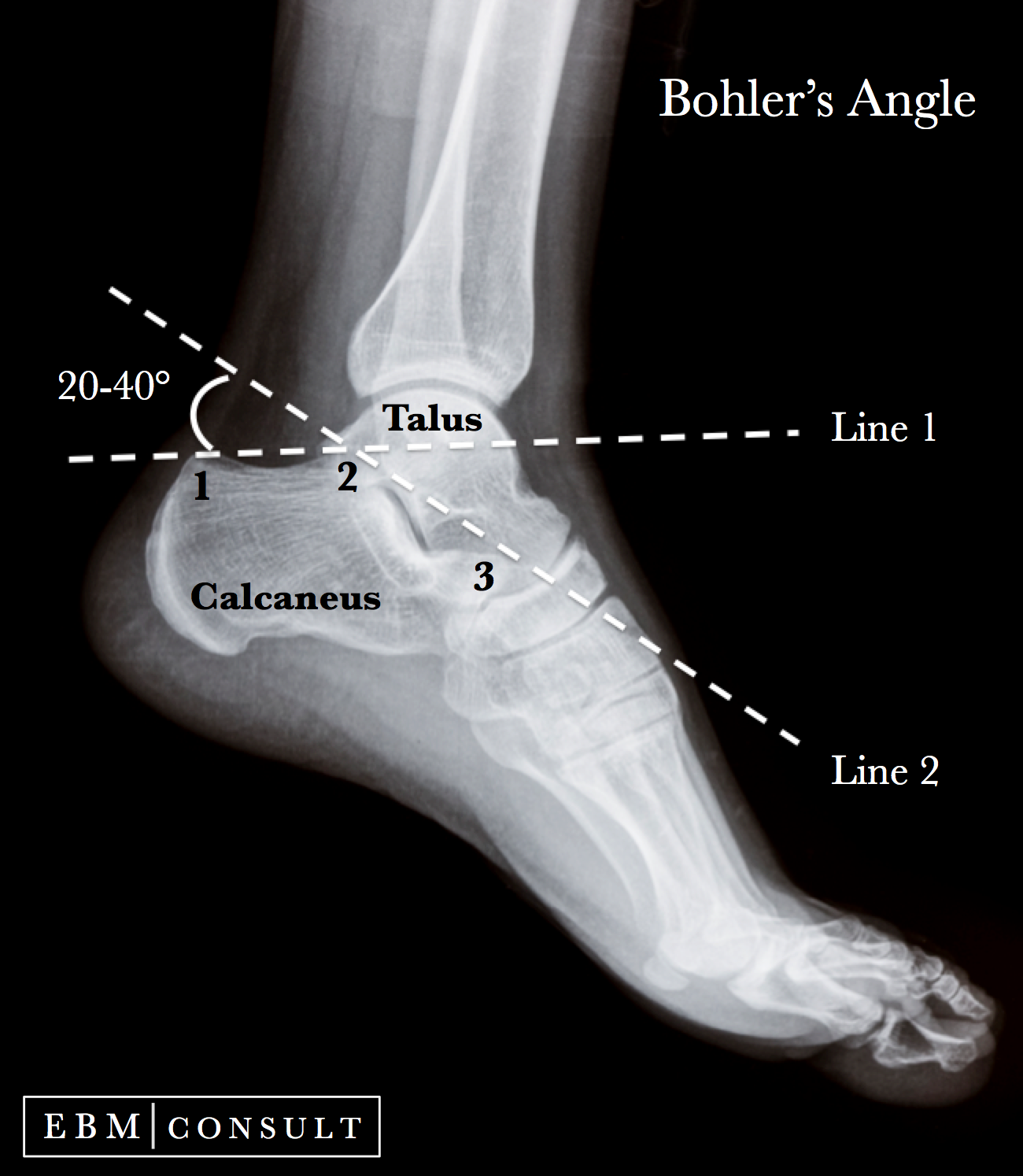 Bohlers Angle on Xray for Calcaneus Fractures